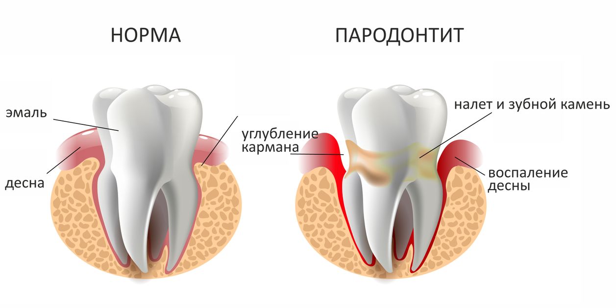 пародонтит